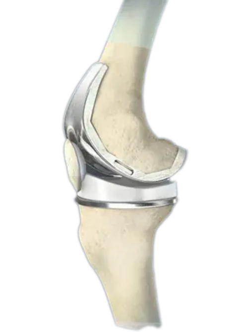 conformis knee replacement hardware