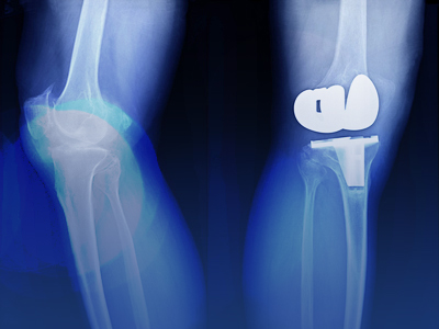 jointReplace400x300_blue knee xray showing joint replacement